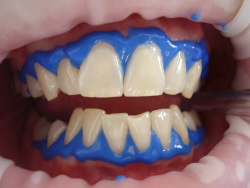 3 Great Tips for Whitening Your Teeth