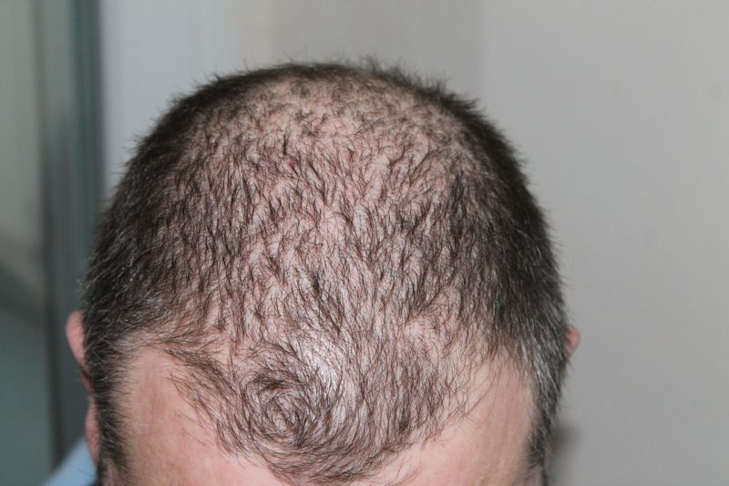 Why Choose Turkey for an FUE Hair Transplant?