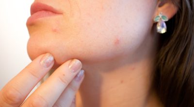 5 Life-Changing Tips for Those Struggling With Acne