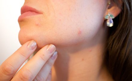 5 Life-Changing Tips for Those Struggling With Acne