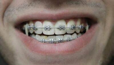 Need Braces? 5 Things to Know Before Your First Appointment