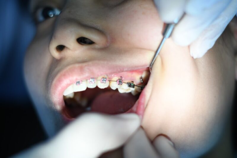 Need Braces? 5 Things to Know Before Your First Appointment